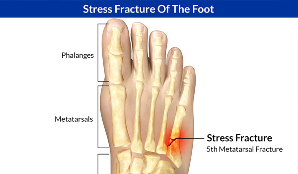 Stress Fracture